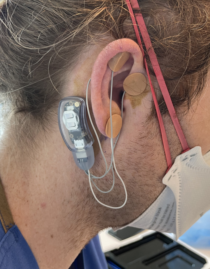 Percutaneous Auricular Nerve Stimulation (Neuromodulation) for Analgesia and Opioid-Sparing Following Knee and Hip Arthroplasty: A Proof-of-Concept Case Series.