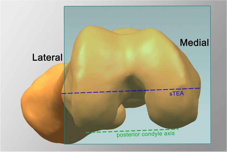 Could surgical transepicondylar axis be identified accurately in preoperative 3D planning for total knee arthroplasty? A reproducibility study based on 3D-CT.