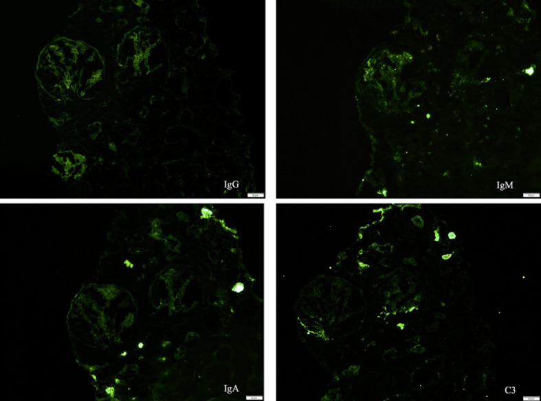 Antineutrophil Cytoplasmic Autoantibody-Negative Pauci-Immune Crescentic Glomerulonephritis in a Patient with Systemic Lupus Erythematosus.