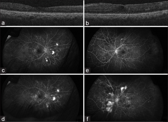 Hypertension: A Cause of Bilateral Proliferative Retinopathy.