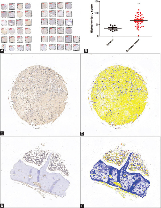 PLCE1 is a poor prognostic marker and may promote immune escape from osteosarcoma by the CD70-CD27 signaling pathway.