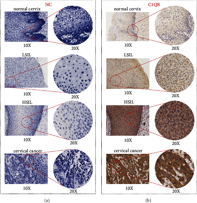 Detection of Complement C1q B Chain Overexpression and Its Latent Molecular Mechanisms in Cervical Cancer Tissues Using Multiple Methods.