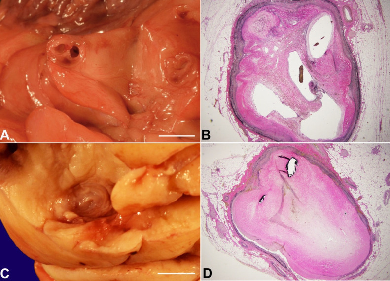 Oblivion: autopsy findings of a 31-year-old man with sudden cardiac arrest, a case report of a sequalae of Kawasaki disease.