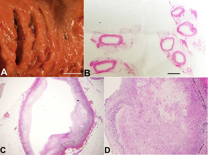 Oblivion: autopsy findings of a 31-year-old man with sudden cardiac arrest, a case report of a sequalae of Kawasaki disease.