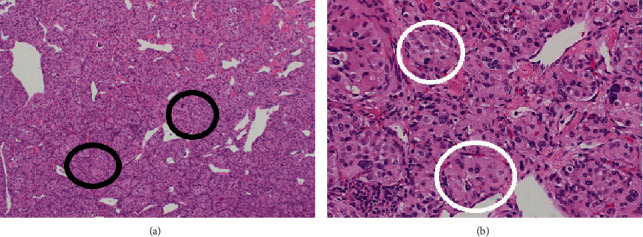 A Rare Case of a Right Atrial Paraganglioma in an Individual with the SHDB Mutation.