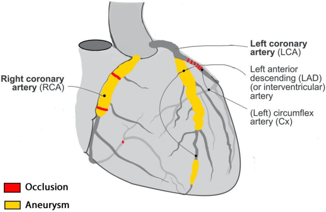 Oblivion: autopsy findings of a 31-year-old man with sudden cardiac arrest, a case report of a sequalae of Kawasaki disease.