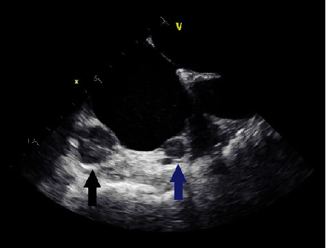A Rare Case of a Right Atrial Paraganglioma in an Individual with the SHDB Mutation.