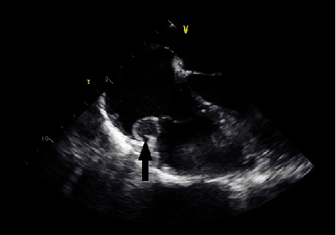 A Rare Case of a Right Atrial Paraganglioma in an Individual with the SHDB Mutation.