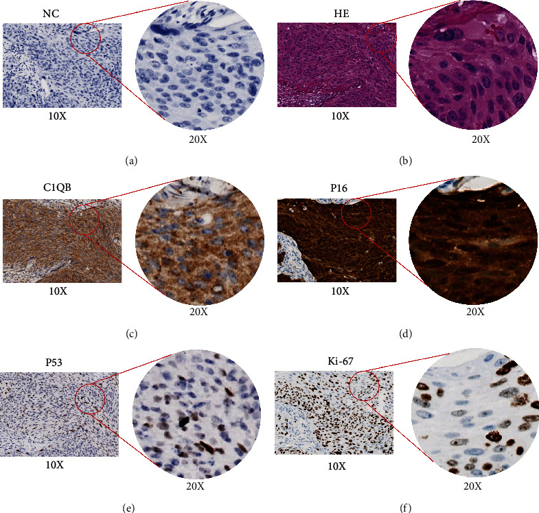 Detection of Complement C1q B Chain Overexpression and Its Latent Molecular Mechanisms in Cervical Cancer Tissues Using Multiple Methods.