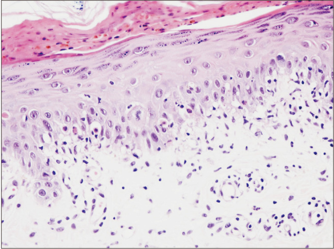 Hand-Foot-Mouth Disease Mimicking Erythema Multiforme in an Immunocompetent Adult.