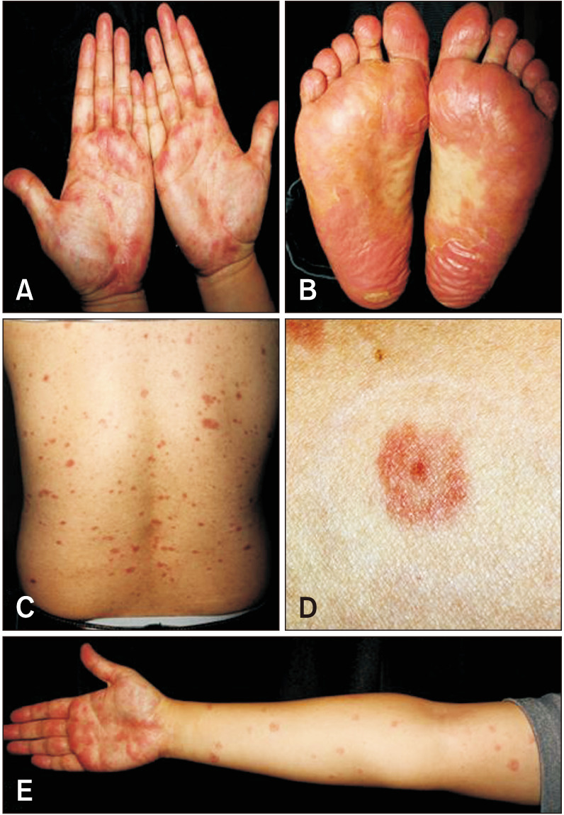 Hand-Foot-Mouth Disease Mimicking Erythema Multiforme in an Immunocompetent Adult.