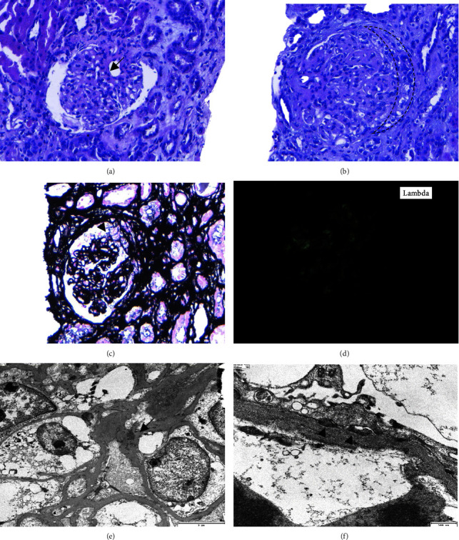 An Exceptional Case of Light Chain Only Variant of Proliferative Glomerulonephritis with Monoclonal Immunoglobulin Deposits Secondary to Chronic Lymphocytic Leukemia: A Case Report and Review of the Literature.