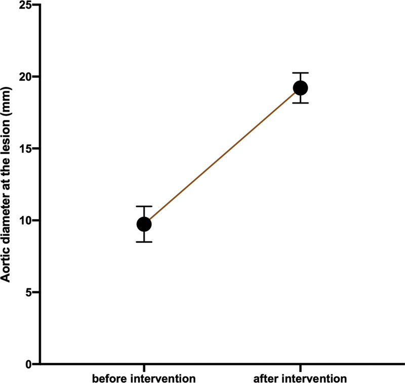 Evaluating the Effectiveness of Stenting for Aortic Coarctation.