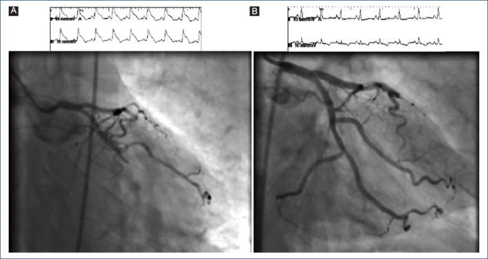 Malignant coronary vasospasm refractory to nitrates: Using clevidipine as an emergent coronary vasodilator.