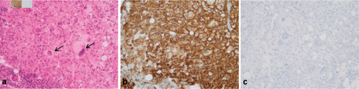 Dramatic Response After Switching MEK Inhibitors in a Patient With Refractory Mixed Histiocytosis.