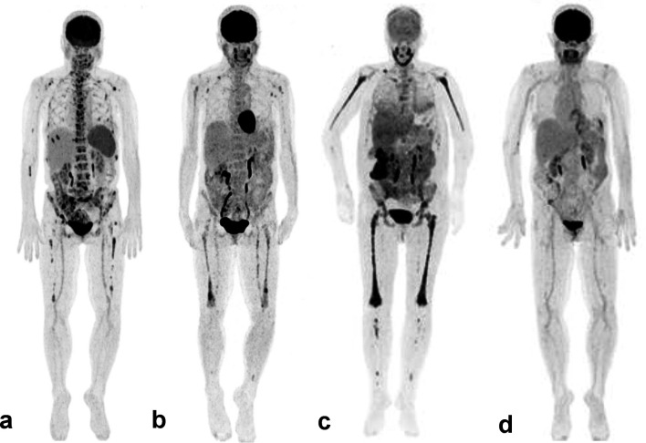 Dramatic Response After Switching MEK Inhibitors in a Patient With Refractory Mixed Histiocytosis.