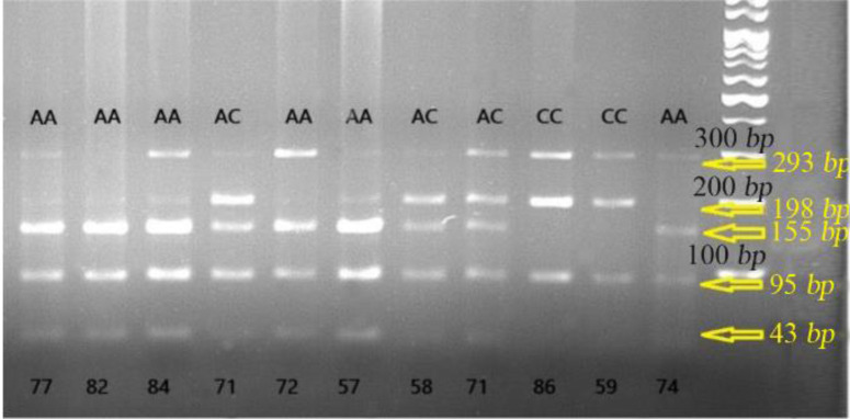 Association between <i>PTCH1</i> and <i>RAD54B</i> Single-Nucleotide Polymorphisms and Non-syndromic Orofacial Clefts in the Northeast Population of Iran.