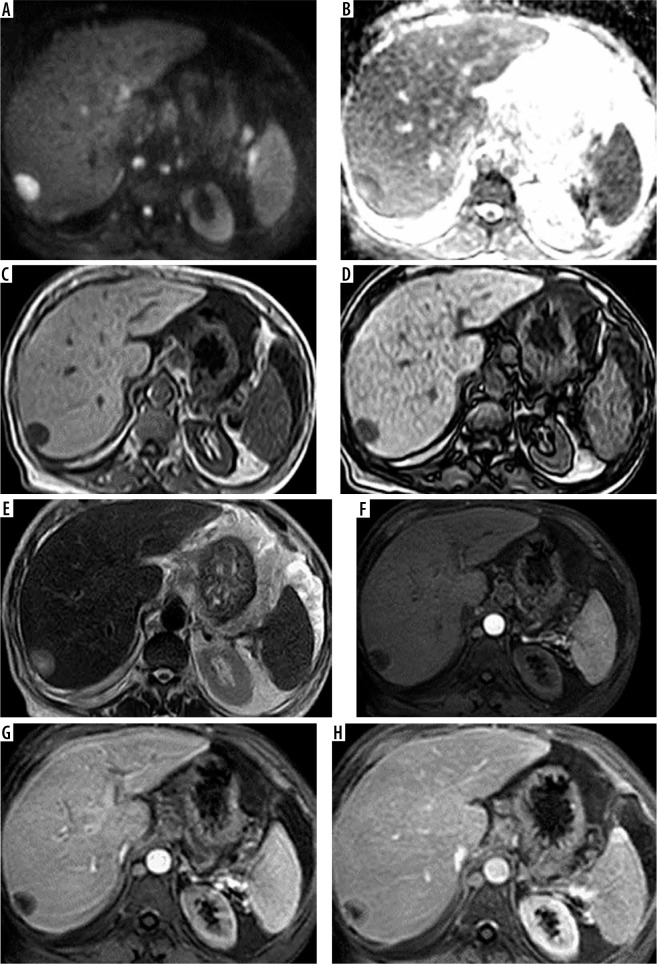 The role of three different contrast-enhanced, abbreviated MRI protocols as a screening tool of hepatocellular carcinoma in patients with chronic hepatitis C virus infection.