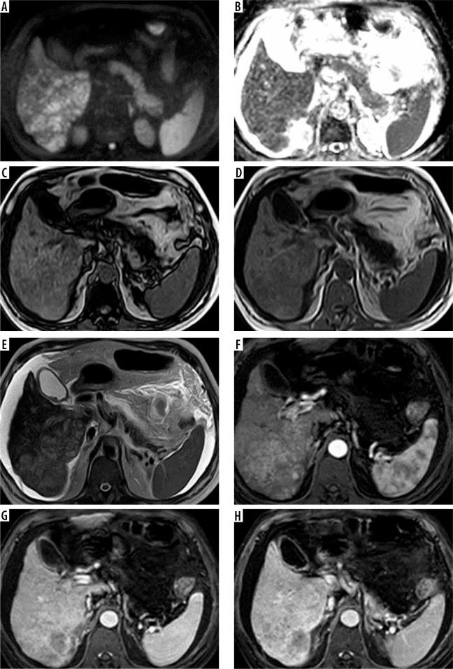 The role of three different contrast-enhanced, abbreviated MRI protocols as a screening tool of hepatocellular carcinoma in patients with chronic hepatitis C virus infection.