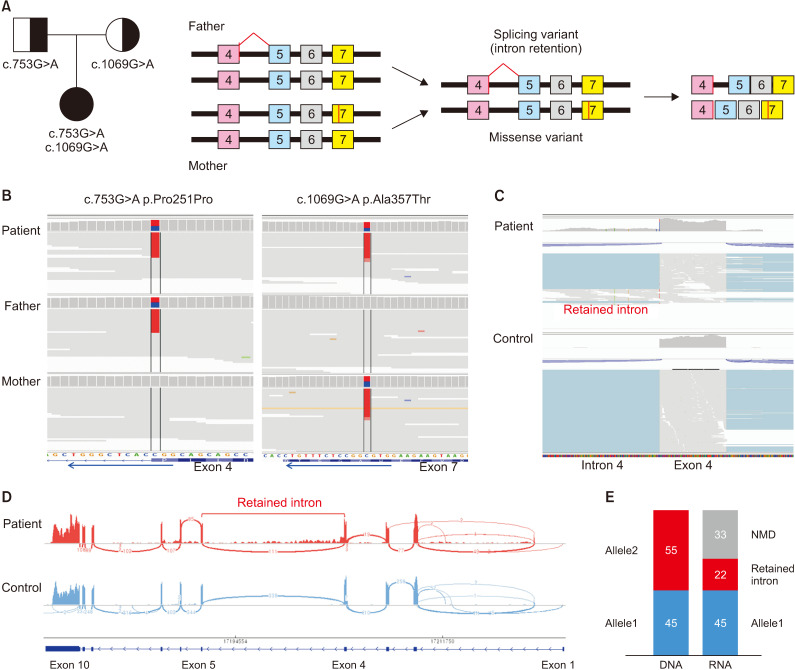 Adenosine Deaminase 2 Deficiency Caused by Biallele Variants Including Splicing Variant: The First Case in Korea.