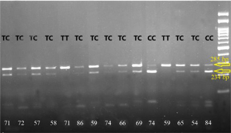 Association between <i>PTCH1</i> and <i>RAD54B</i> Single-Nucleotide Polymorphisms and Non-syndromic Orofacial Clefts in the Northeast Population of Iran.