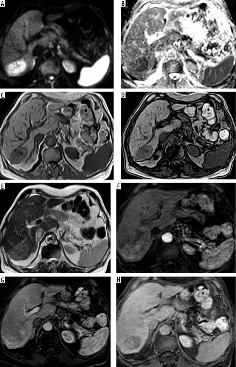 The role of three different contrast-enhanced, abbreviated MRI protocols as a screening tool of hepatocellular carcinoma in patients with chronic hepatitis C virus infection.