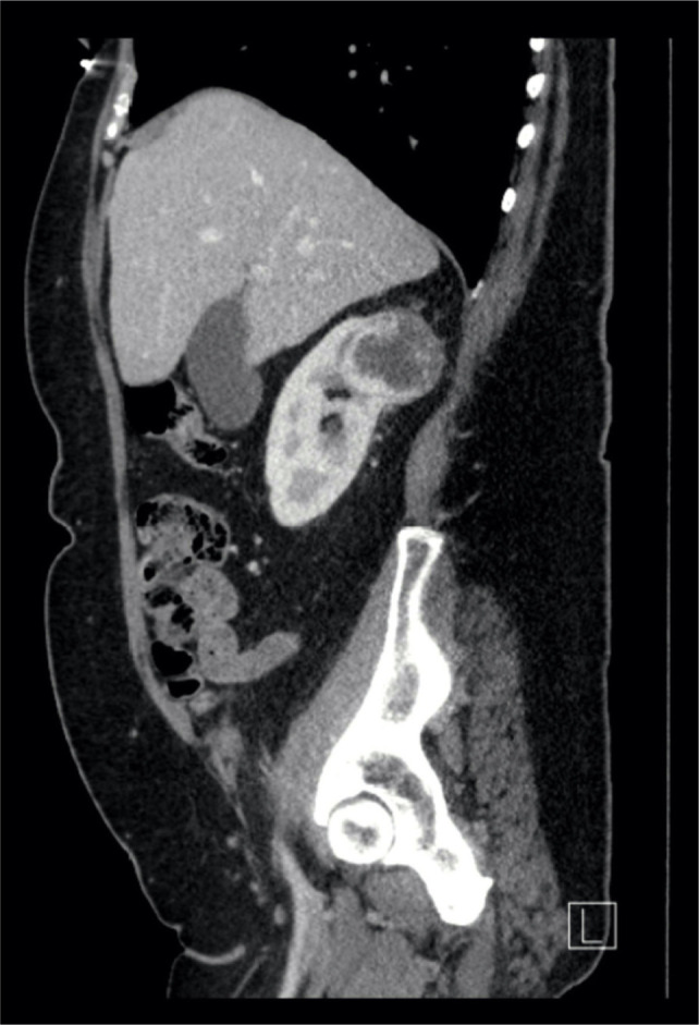 Partial Nephrectomy for T1b/T2 Renal Mass: An Added Shift from Radical Nephrectomy.