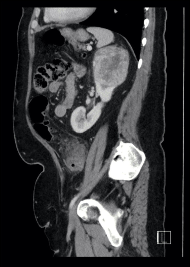 Partial Nephrectomy for T1b/T2 Renal Mass: An Added Shift from Radical Nephrectomy.