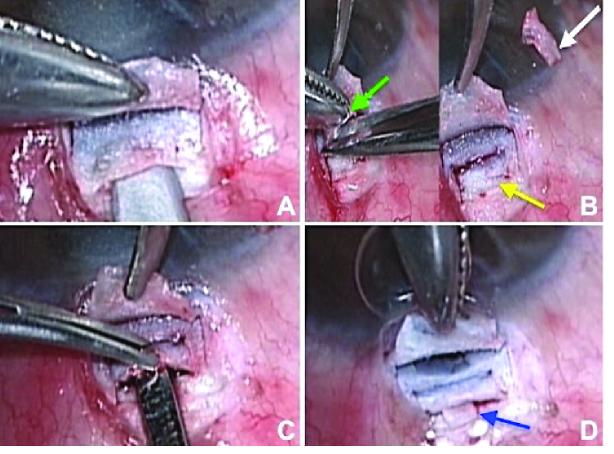 Trabeculectomy Augmented with Limited Deep Sclerectomy and Cyclodialysis with Use of Scleral Tissue as a Spacer.