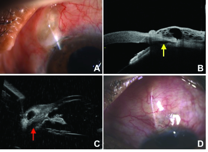 Trabeculectomy Augmented with Limited Deep Sclerectomy and Cyclodialysis with Use of Scleral Tissue as a Spacer.