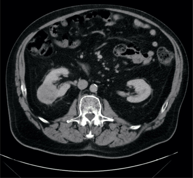 Partial Nephrectomy for T1b/T2 Renal Mass: An Added Shift from Radical Nephrectomy.