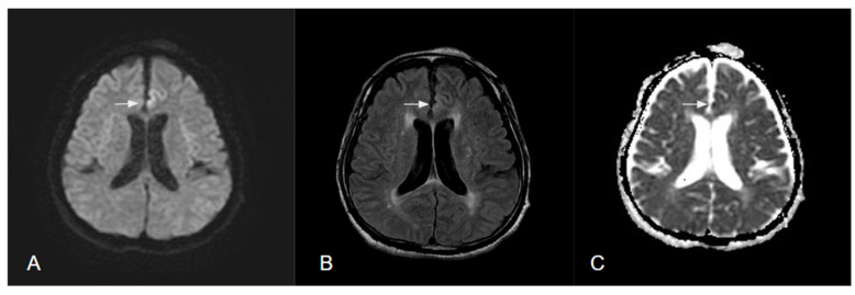 Brain Imaging in Epilepsy-Focus on Diffusion-Weighted Imaging.