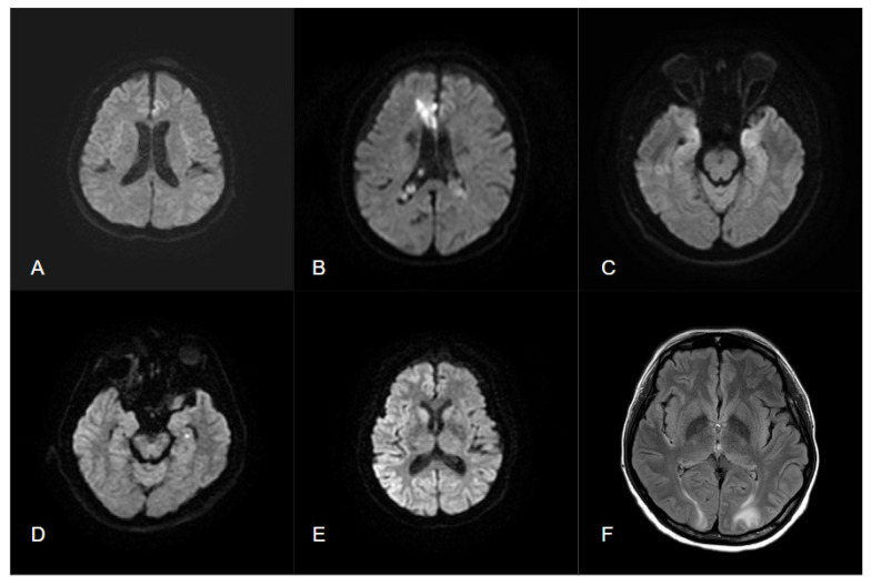 Brain Imaging in Epilepsy-Focus on Diffusion-Weighted Imaging.