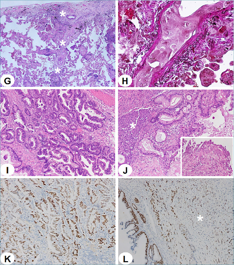 Metastatic mucinous ovarian carcinoma simulating lung primary: an integrated diagnostic lesson.