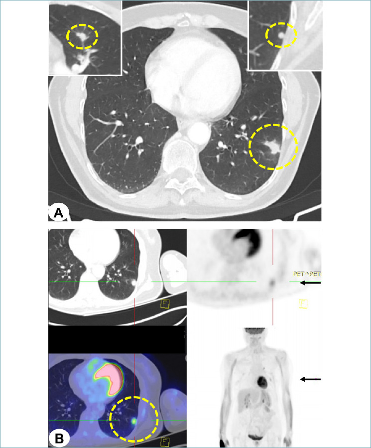 Metastatic mucinous ovarian carcinoma simulating lung primary: an integrated diagnostic lesson.