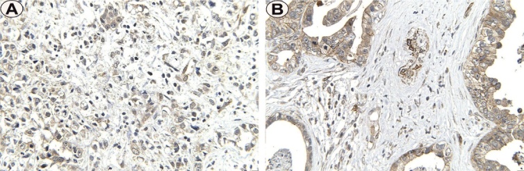 Immunoexpression of Claudin 4 in Gastric Adenocarcinomas.