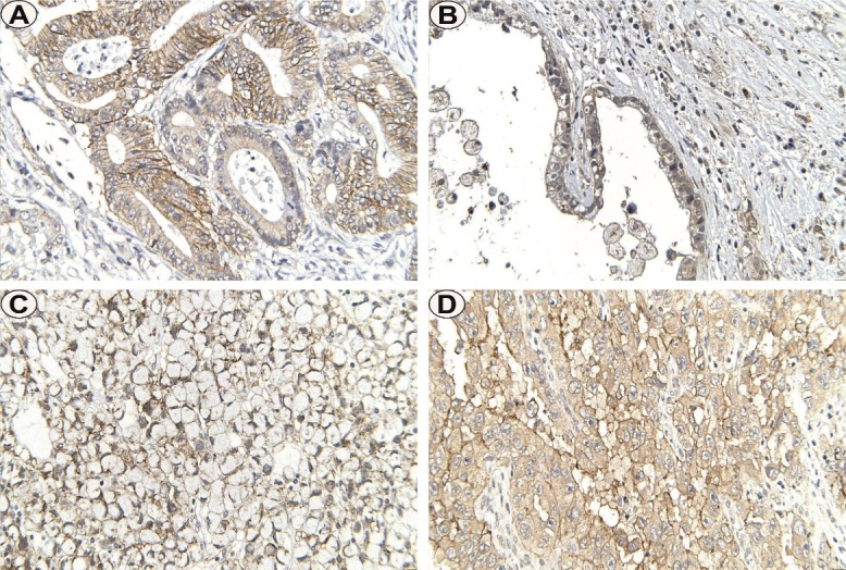 Immunoexpression of Claudin 4 in Gastric Adenocarcinomas.