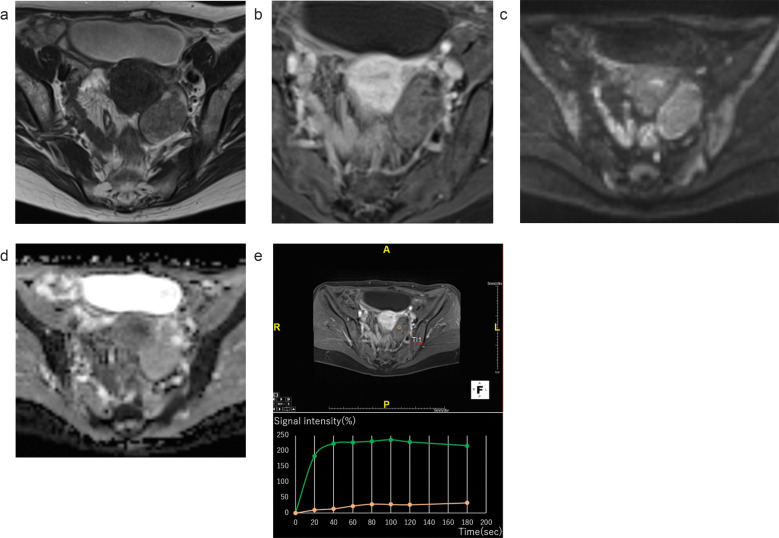 Diagnostic Value of DCE-MRI for Differentiating Malignant Adnexal Masses Compared with Contrast-enhanced-T1WI.