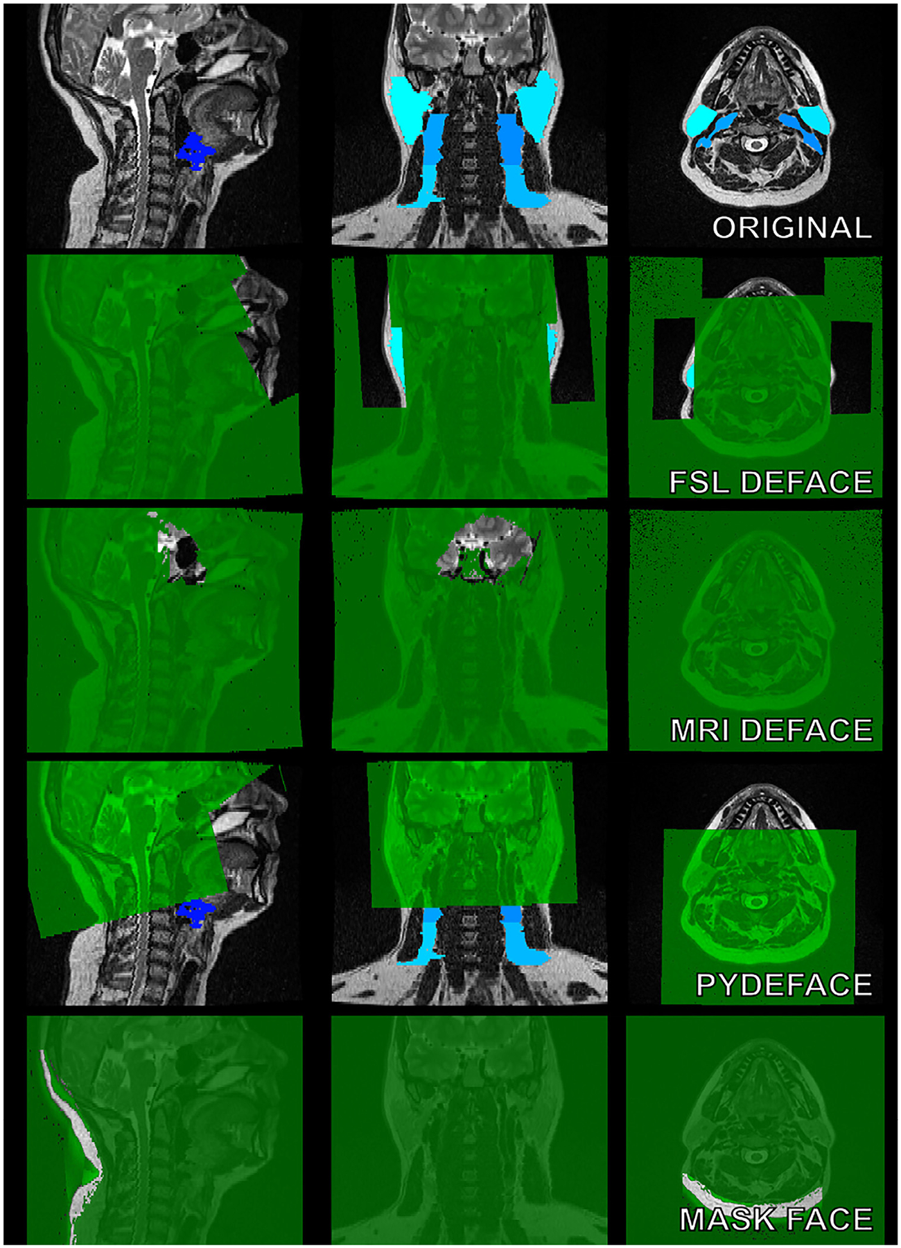 Artificial Intelligence for Radiation Oncology Applications Using Public Datasets