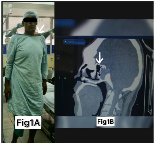 Anesthetic Challenges in a Patient of Morquio Syndrome Associated with Acromegaly.