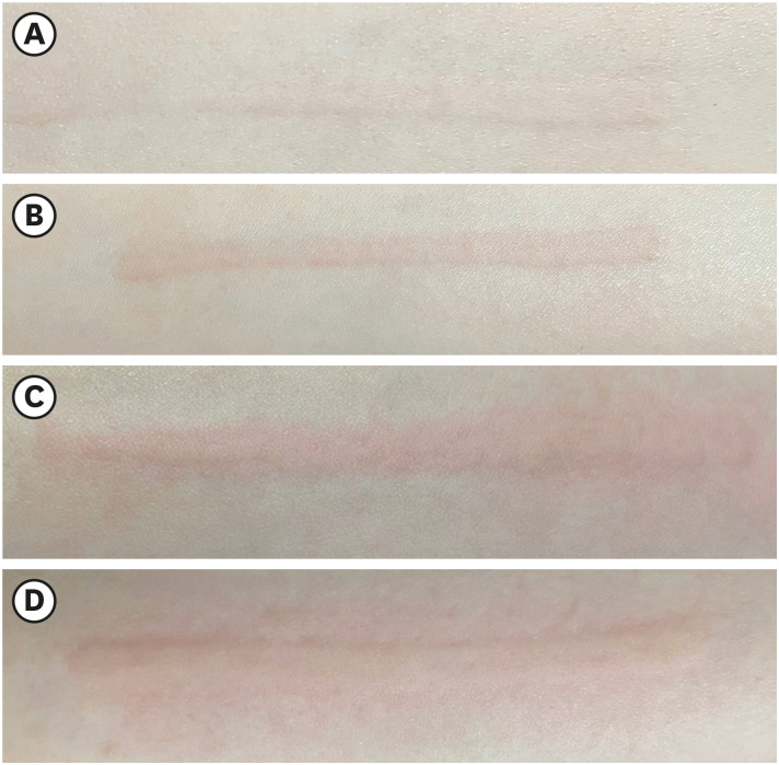 Natural history and clinical course of patients with dermographism in a tropical country: a questionnaire-based survey.