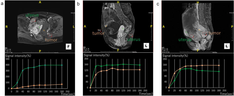 Diagnostic Value of DCE-MRI for Differentiating Malignant Adnexal Masses Compared with Contrast-enhanced-T1WI.