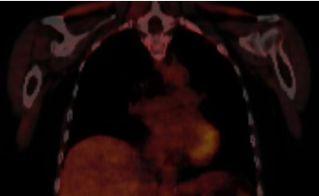 A Case Report of Immune Checkpoint Inhibitor-Induced Aortitis Treated with Tocilizumab.