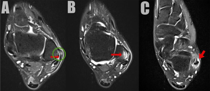 The Ankle Fleck Sign Indicating Fibular Avulsion of the Superior Peroneal Retinaculum.