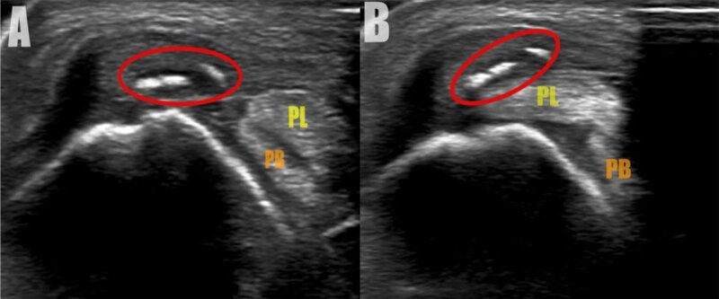 The Ankle Fleck Sign Indicating Fibular Avulsion of the Superior Peroneal Retinaculum.