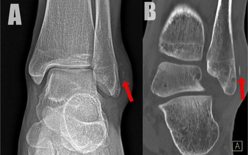 The Ankle Fleck Sign Indicating Fibular Avulsion of the Superior Peroneal Retinaculum.