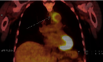 A Case Report of Immune Checkpoint Inhibitor-Induced Aortitis Treated with Tocilizumab.