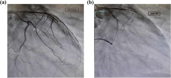 Ventricular fibrillation immediately after the treatment of Graves' disease coexisting with atypical angina and long QT syndrome: a case report.