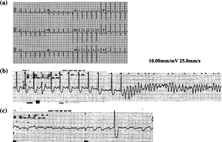 Ventricular fibrillation immediately after the treatment of Graves' disease coexisting with atypical angina and long QT syndrome: a case report.