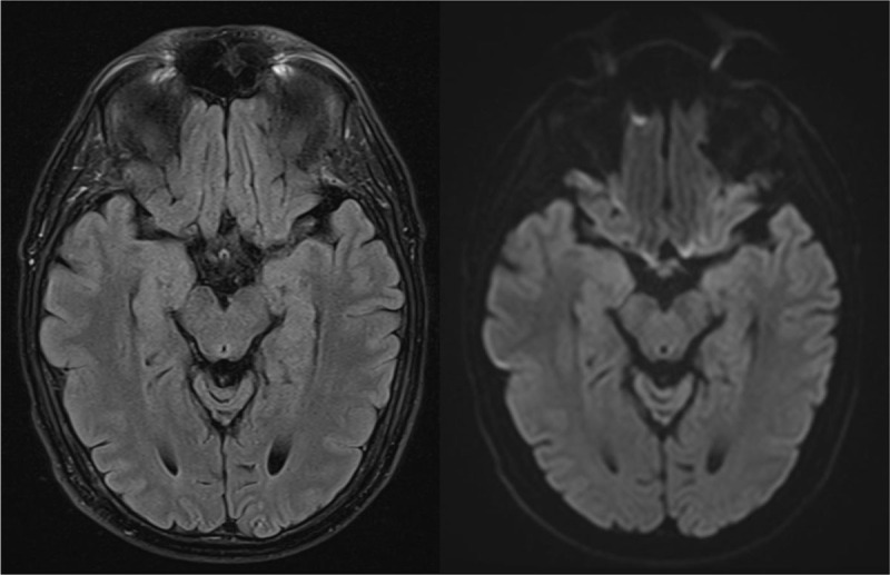 Human Herpesvirus-6 Encephalitis.